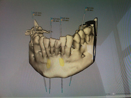 CAD CAM Cirujano Maxilofacial CDMX