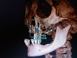 CAD CAM Crujano Maxilofacial en CDMX