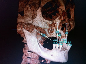 CAD CAM Crujano Maxilofacial en CDMX
