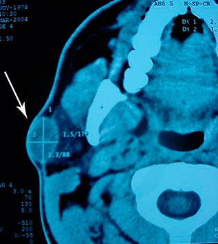 Parotid gland cyst
