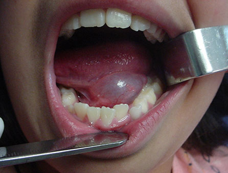 Ranula removal