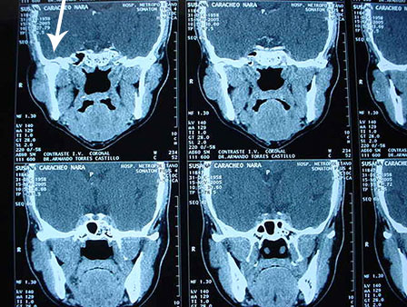 Parotid adenoma treatment