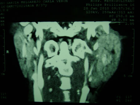 Pleomorphic adenoma treatment