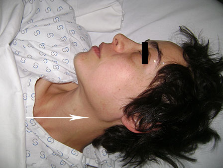 Pleomorphic adenoma treatment