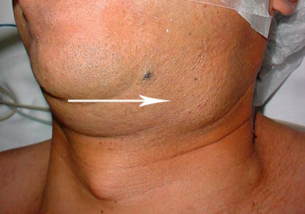 Submaxillary adenoma treatment
