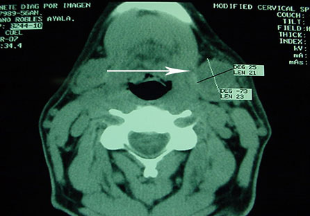 Submaxillary adenoma treatment