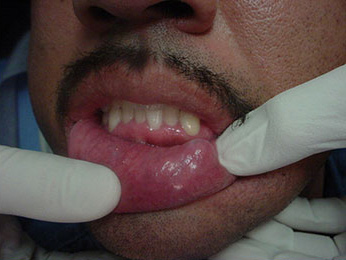 Mucocele treatment