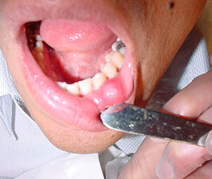 Mucocele treatment