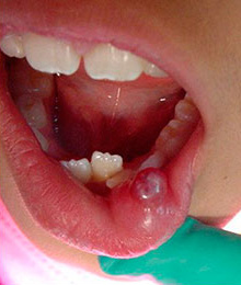 Ranula treatment