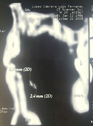 Lingual sialolith treatment