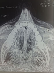 Lingual sialolith treatment