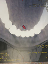 Lingual sialolith treatment