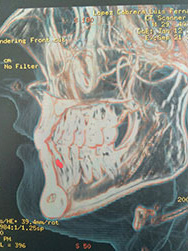 Lingual sialolith treatment