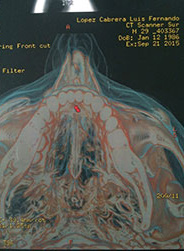 Lingual sialolith treatment