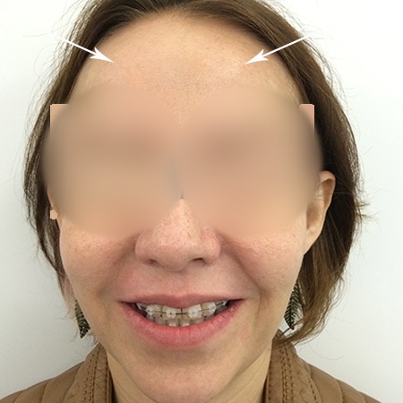 Aplicación de Botox