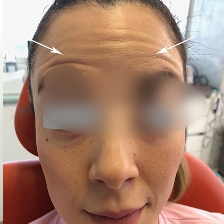 Aplicación de Botox