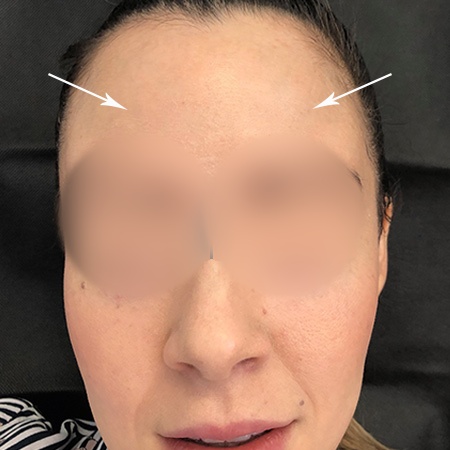 Aplicación de Botox