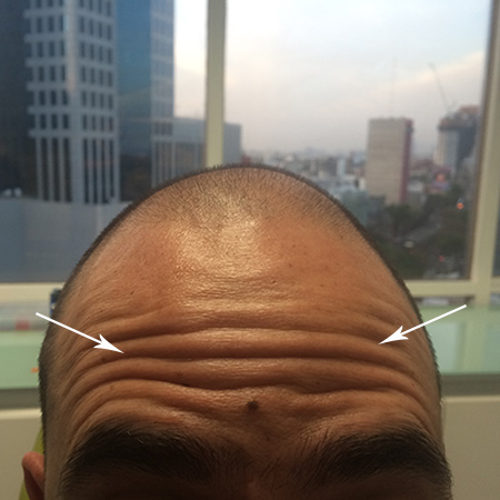 Aplicación de Botox