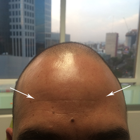 Aplicación de Botox