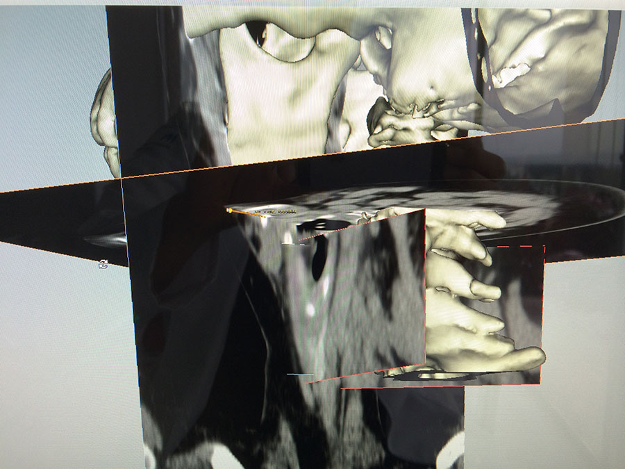 Submandibular gland sialolith