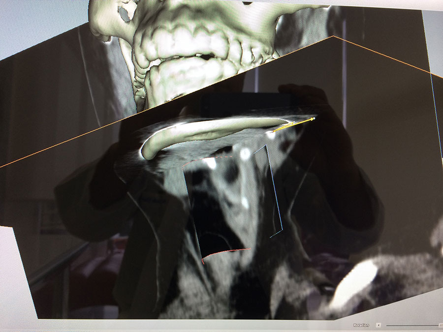 Submandibular gland sialolith
