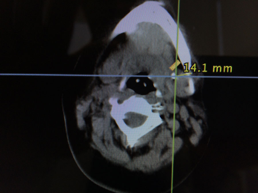Submandibular gland sialolith