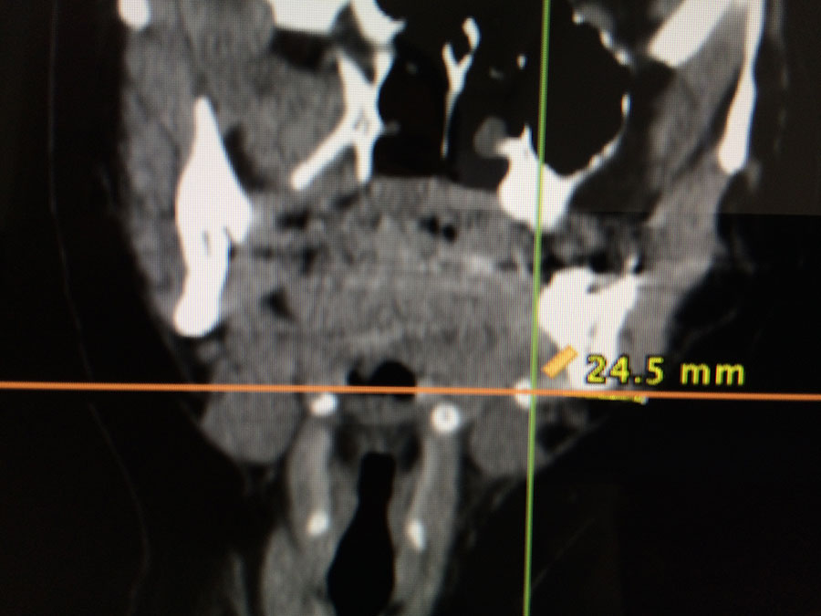 Submandibular gland sialolith