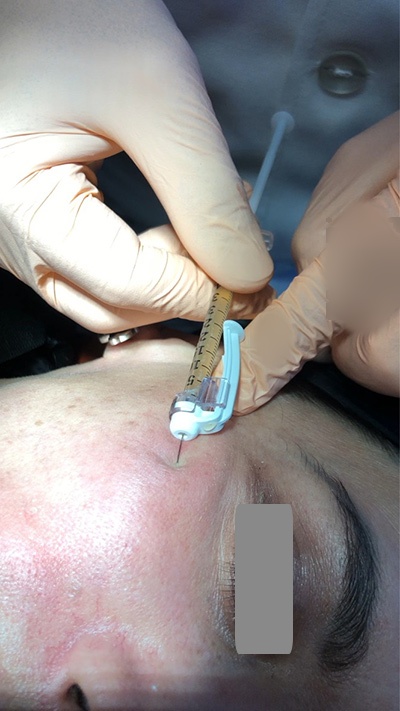 Platelet-rich plasma application