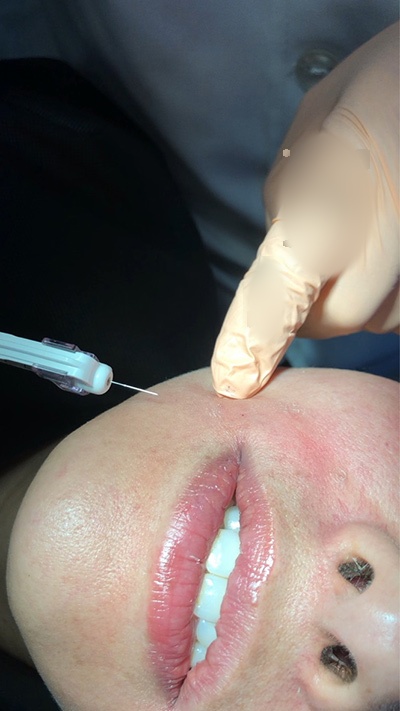 Platelet-rich plasma application