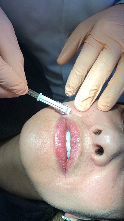 Platelet-rich plasma application