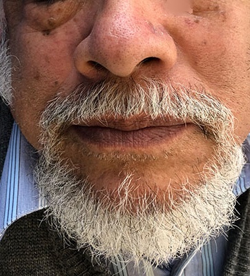 Nasal lipoma