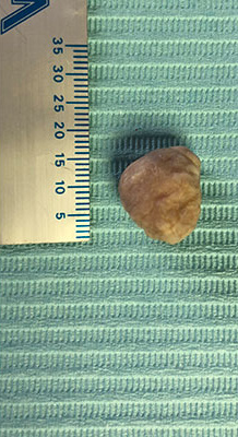 Cheek lipoma