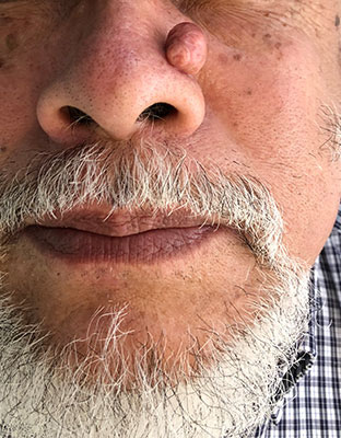 Nasal lipoma
