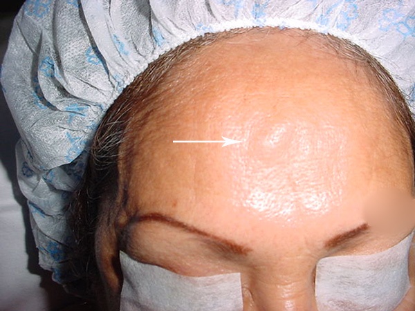 Exostosis Cirujano Maxilofacial CDMX