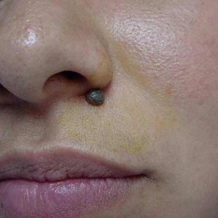 Retiro de lunares por Cirujano Maxilofacial en CDMX