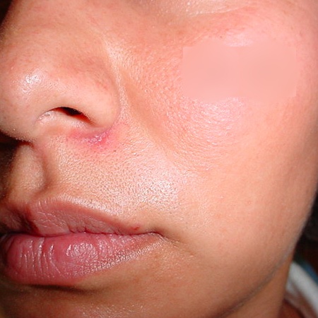 Retiro de lunares por Cirujano Maxilofacial en CDMX