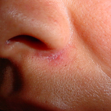 Retiro de lunares por Cirujano Maxilofacial en CDMX