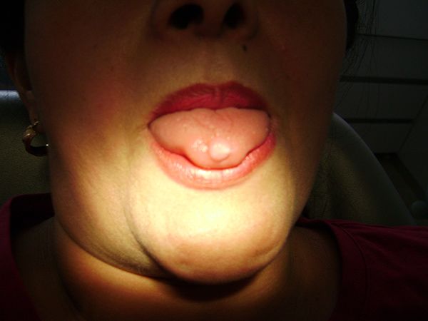 Retiro de fibroma lingual en CDMX