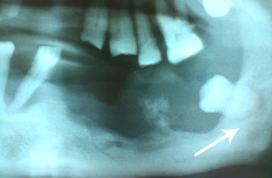 Cirugía Maxilofacial en México