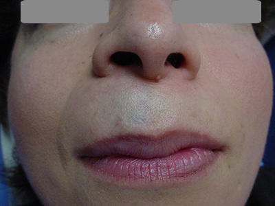 Cirujano Maxilofacial CDMX Hemangioma labial