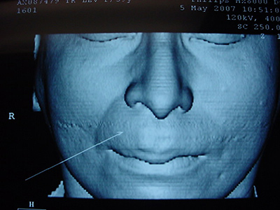 Cirujano Maxilofacial CDMX Hemangioma labial
