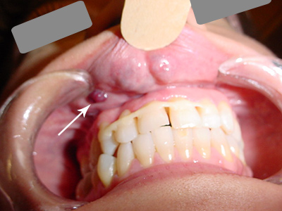 Cirujano Maxilofacial CDMX Hemangioma labial