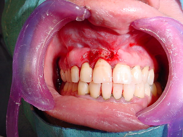 Cirujano Maxilofacial CDMX Retiro de epulis