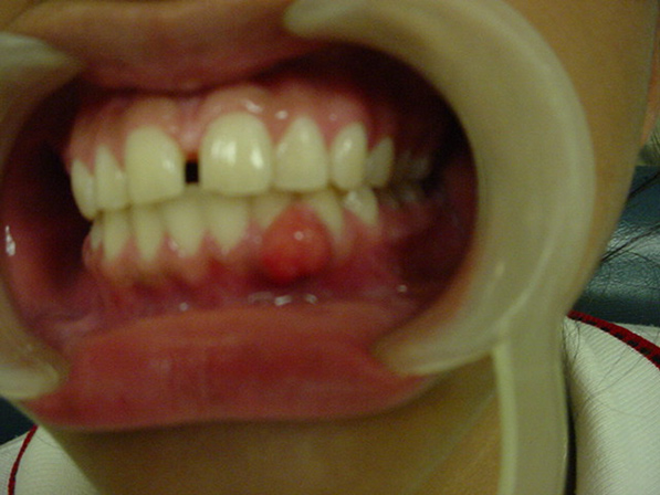 Cirujano Maxilofacial CDMX Retiro de epulis