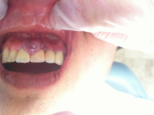 Cirujano Maxilofacial CDMX Retiro de epulis