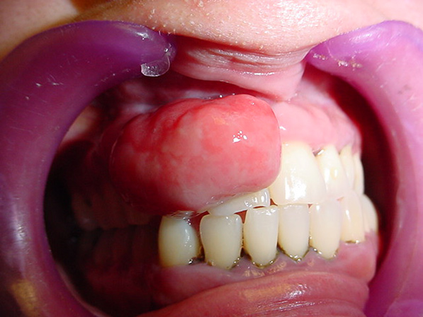 Cirujano Maxilofacial CDMX Retiro de epulis