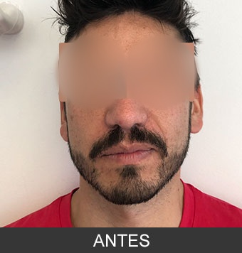 Bichectomía