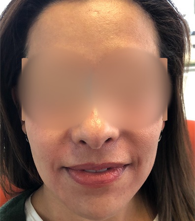 Platelet-rich plasma case