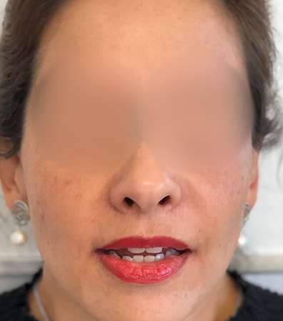 Platelet-rich plasma case