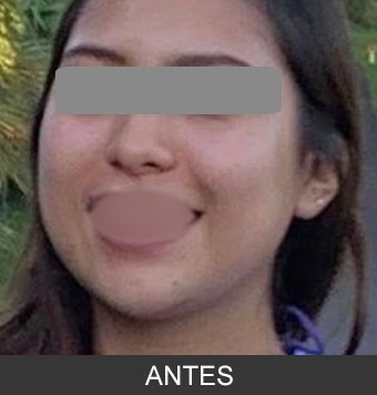 Bichectomía